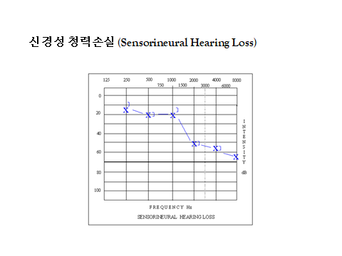 노인성난청이란?